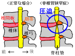 腰痛の原因