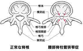 腰痛の原因